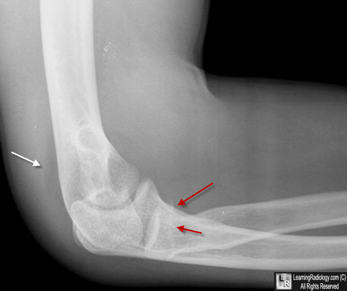 posterior fat pad sign